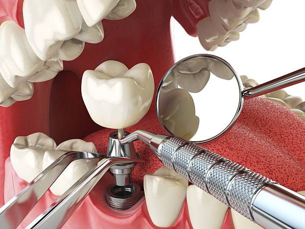 Best Root Canal Emergency Dentist  in Wickerham Manor Fisher, PA